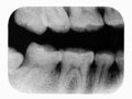 Dental X-ray films